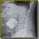Neuromodulation for Refractory Failed Back Surgery Syndrome Patients
